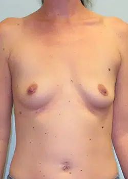 Breast Augmentation Before 1