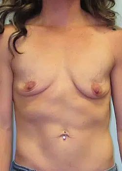 Breast Augmentation Before 1