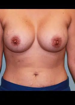 Breast Augmentation After 1