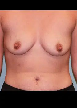 Breast Augmentation Before 1