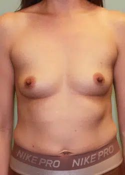 Breast Augmentation Before 1