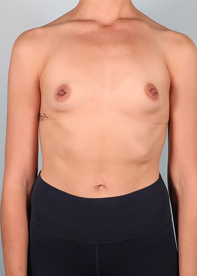 Breast Augmentation Before 1