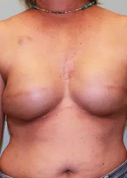 Breast Reconstruction After 1