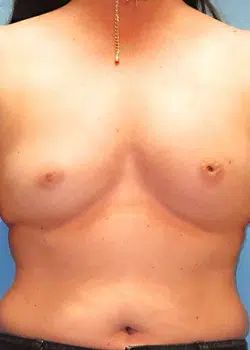 Breast Reconstruction Before 1