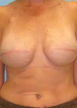 Breast Reconstruction After 1