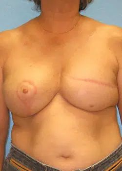 Breast Reconstruction After 1