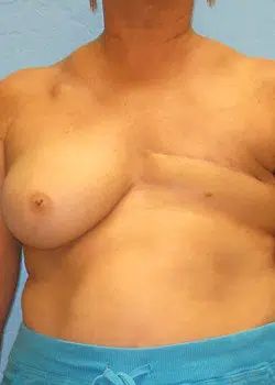 Breast Reconstruction Before 1