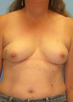 Breast Reconstruction Before 1