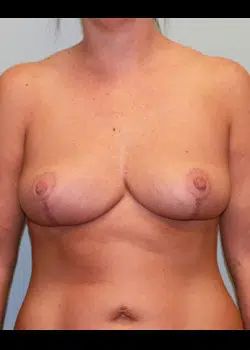 Breast Reduction After 1