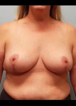 Breast Reduction After 1