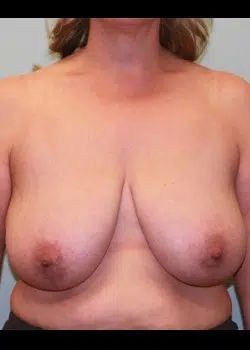 Breast Reduction Before 1