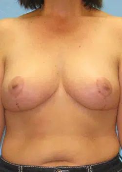 Breast Reduction After 1