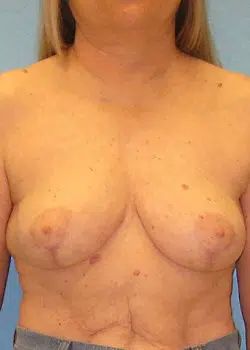 Breast Reduction After 1