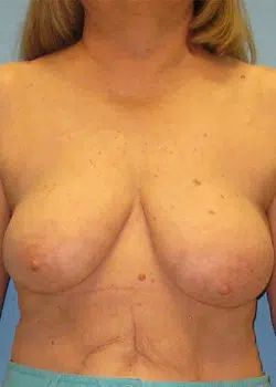 Breast Reduction Before 1