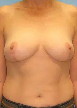 Breast Reduction After 1