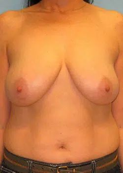 Breast Reduction Before 1