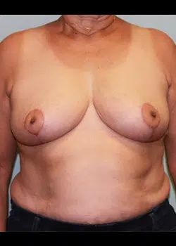 Breast Reduction After 1