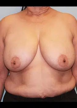 Breast Reduction Before 1