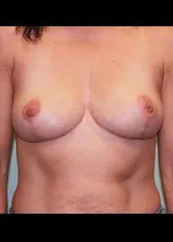 Breast Reduction After 1