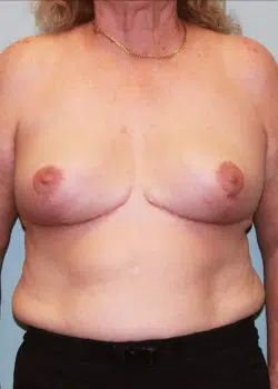 Breast Reduction After 1