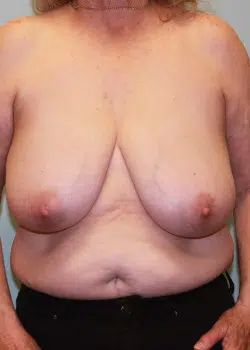 Breast Reduction Before 1