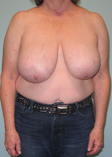 Breast Reduction Before 1