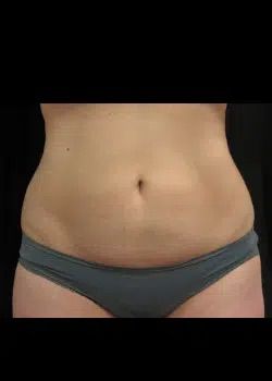 Coolsculpting After 1