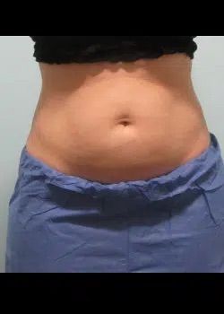 Coolsculpting After 1