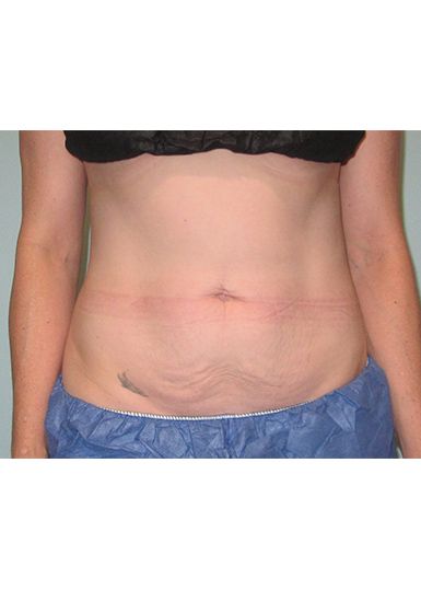 Coolsculpting After 1