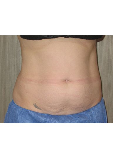 Coolsculpting Before 1