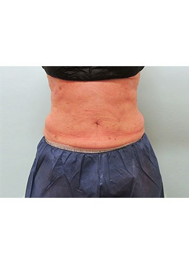 Coolsculpting After 1