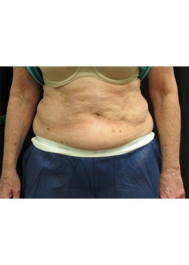 Coolsculpting Before 1