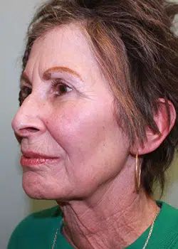 Facelift Before 1