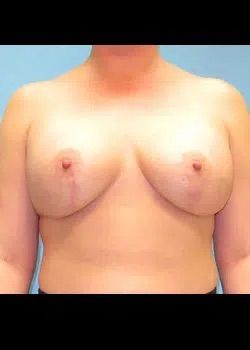 Breast Lift After 1