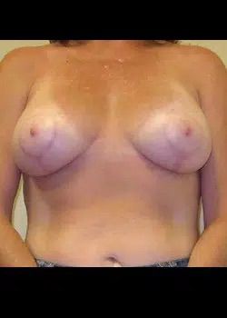 Breast Lift After 1