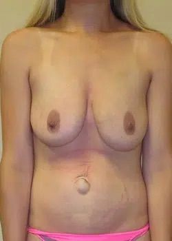 Breast Lift before