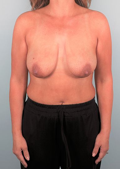 Breast Lift Before 1