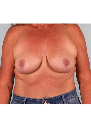 Breast Lift (Without Implants) After 1