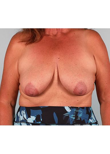 Breast Lift (Without Implants) Before 1