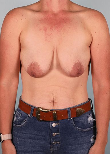 Breast Lift (Without Implants) Before 1