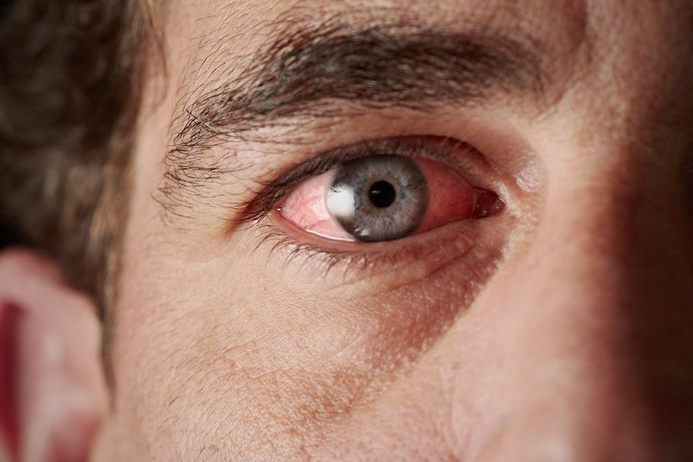 Can Blepharitis Cause Blurry Vision?