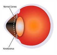 keratoconus