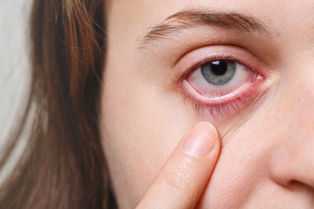 Understanding Meibomian Gland Dysfunction (MGD) and Its Impact on Eye Health