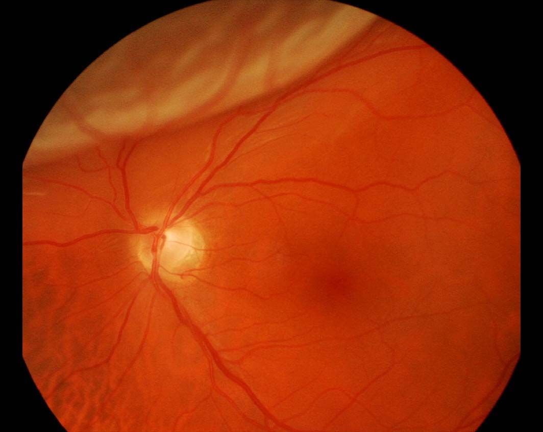 Retinal Detachment Treatment in Elmhurst, IL Skowron Eye Care