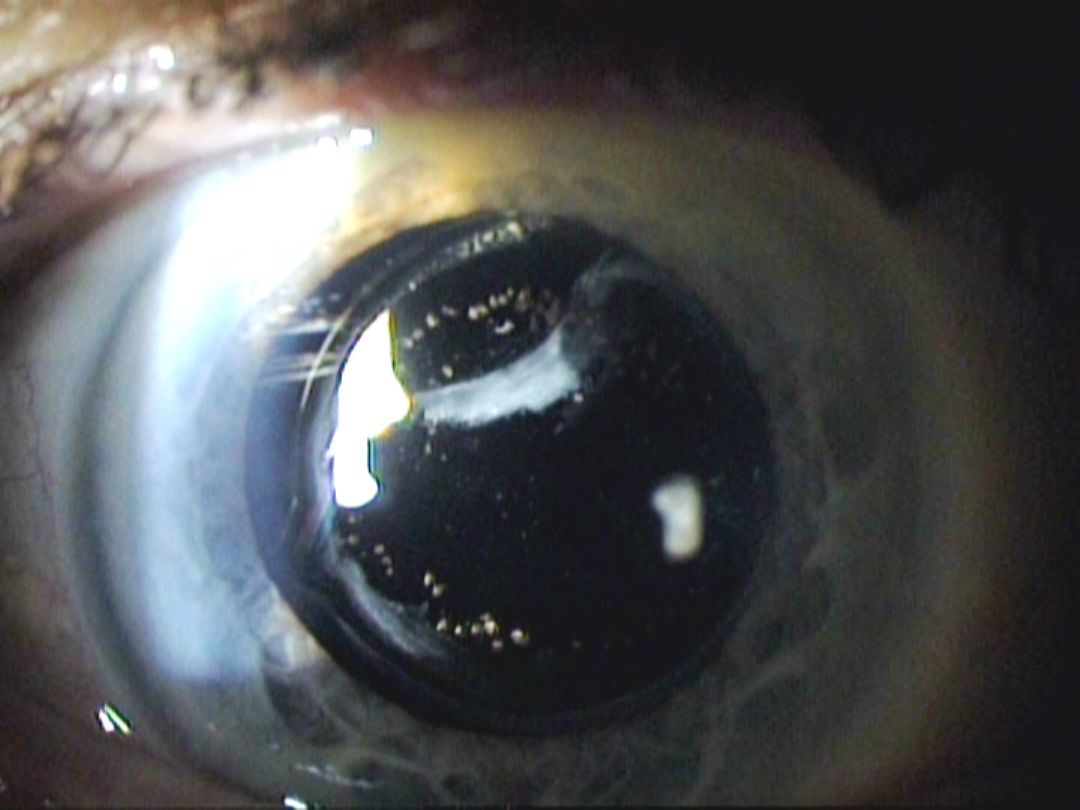 Light Flashes In Eye When Turning Head Shelly Lighting