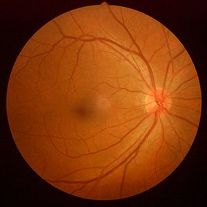 Retinal Imaging Testing