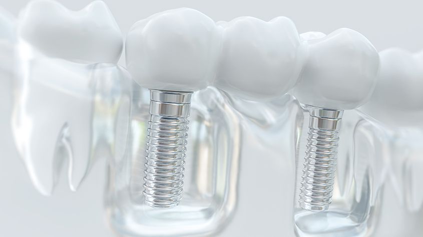 Dental Implant