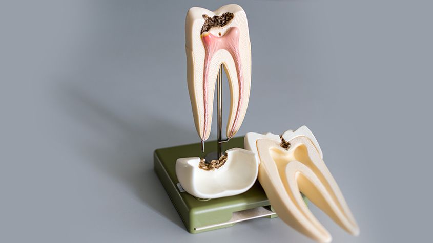 Root Canals