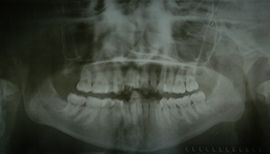 After surgery and bone graft with PRF (21 years old patient)