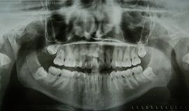 Before surgery and bone graft with PRF (21 years old patient)